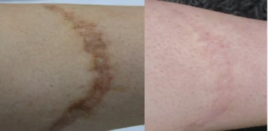 Surgical scars treatment cutis dermatology brisbane 2