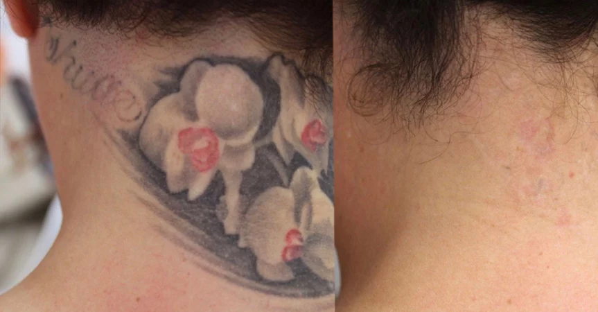 Tattoo Removal treatment cutis dermatology brisbane