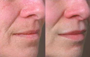 Volbella LipsSmokerslines treatment cutis dermatology brisbane