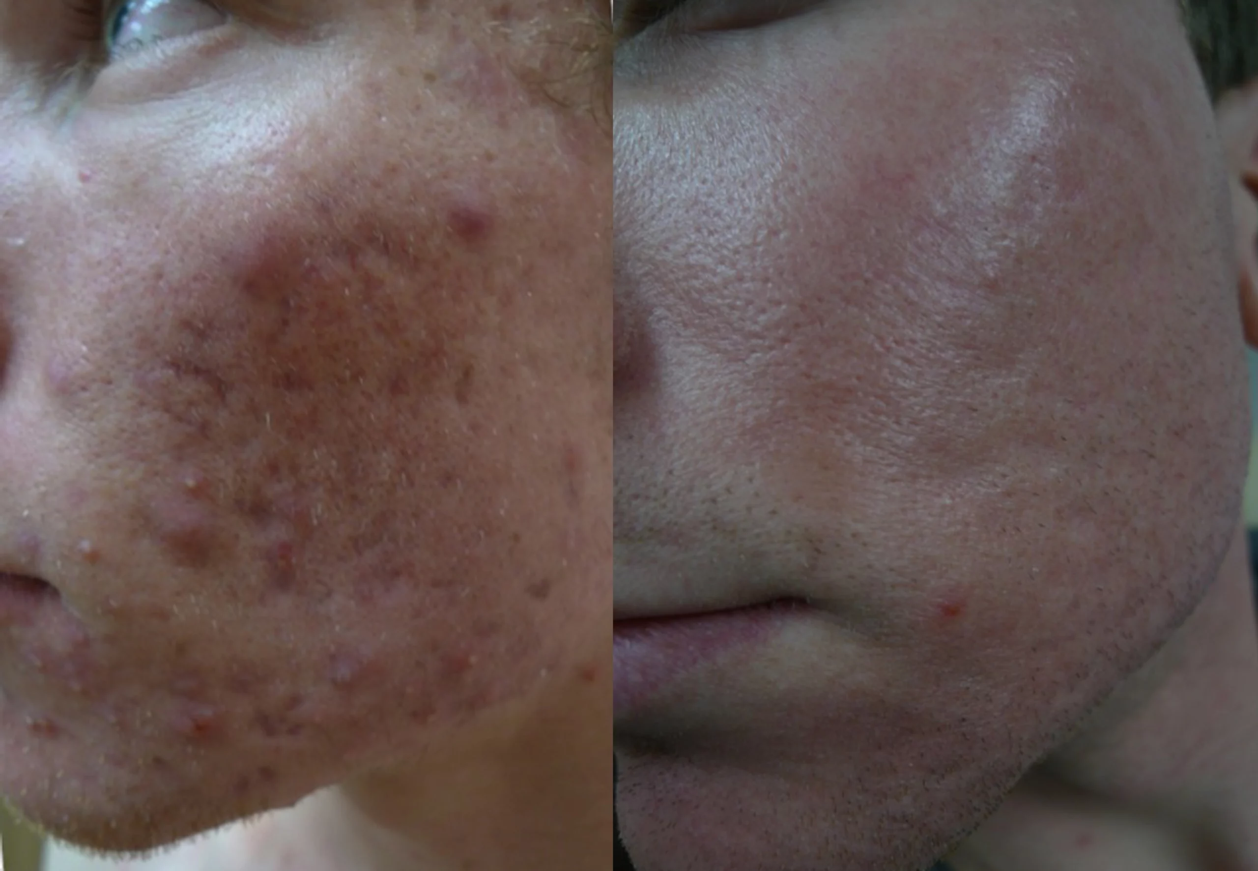 acne scar filler treatment cutis dermatology brisbane scaled