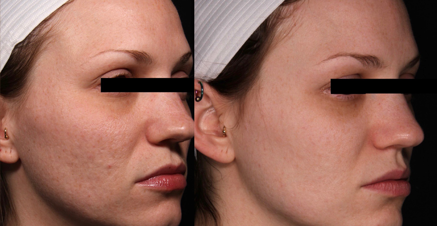 acne scar treatment cutis dermatology brisbane 1