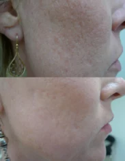 acne scars treatment cutis dermatology brisbane 1