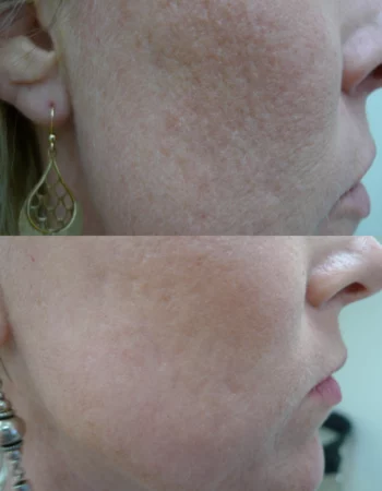 acne scars treatment cutis dermatology brisbane 1