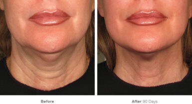 before after ultherapy results neck3