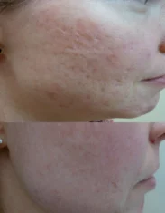 brisbane acne scar removal treatment cutis dermatology brisbane