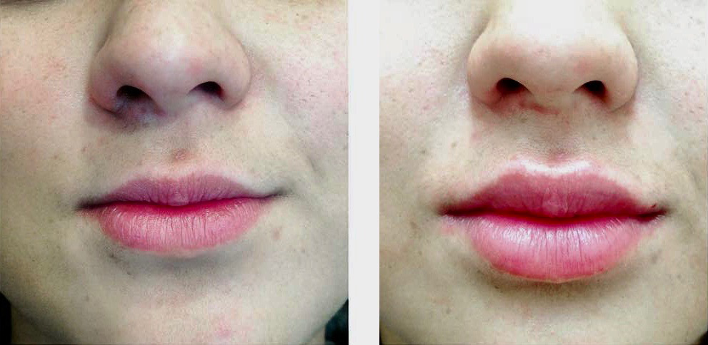 dermal filler lips Perioral treatment cutis dermatology brisbane