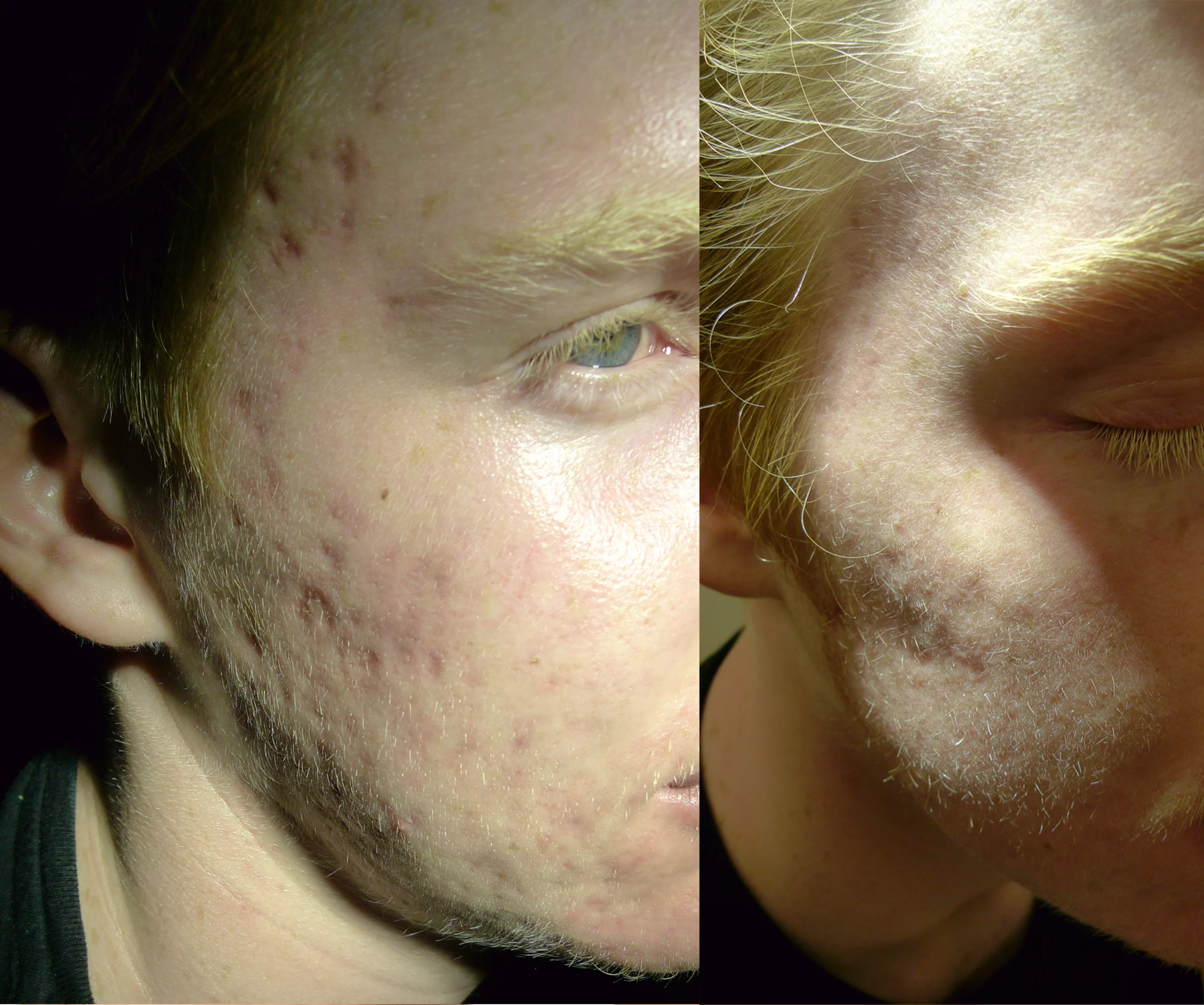 ematrix for scars treatment cutis dermatology brisbane scaled