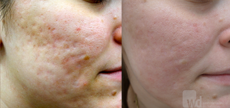 filler for acne scars treatment cutis dermatology brisbane
