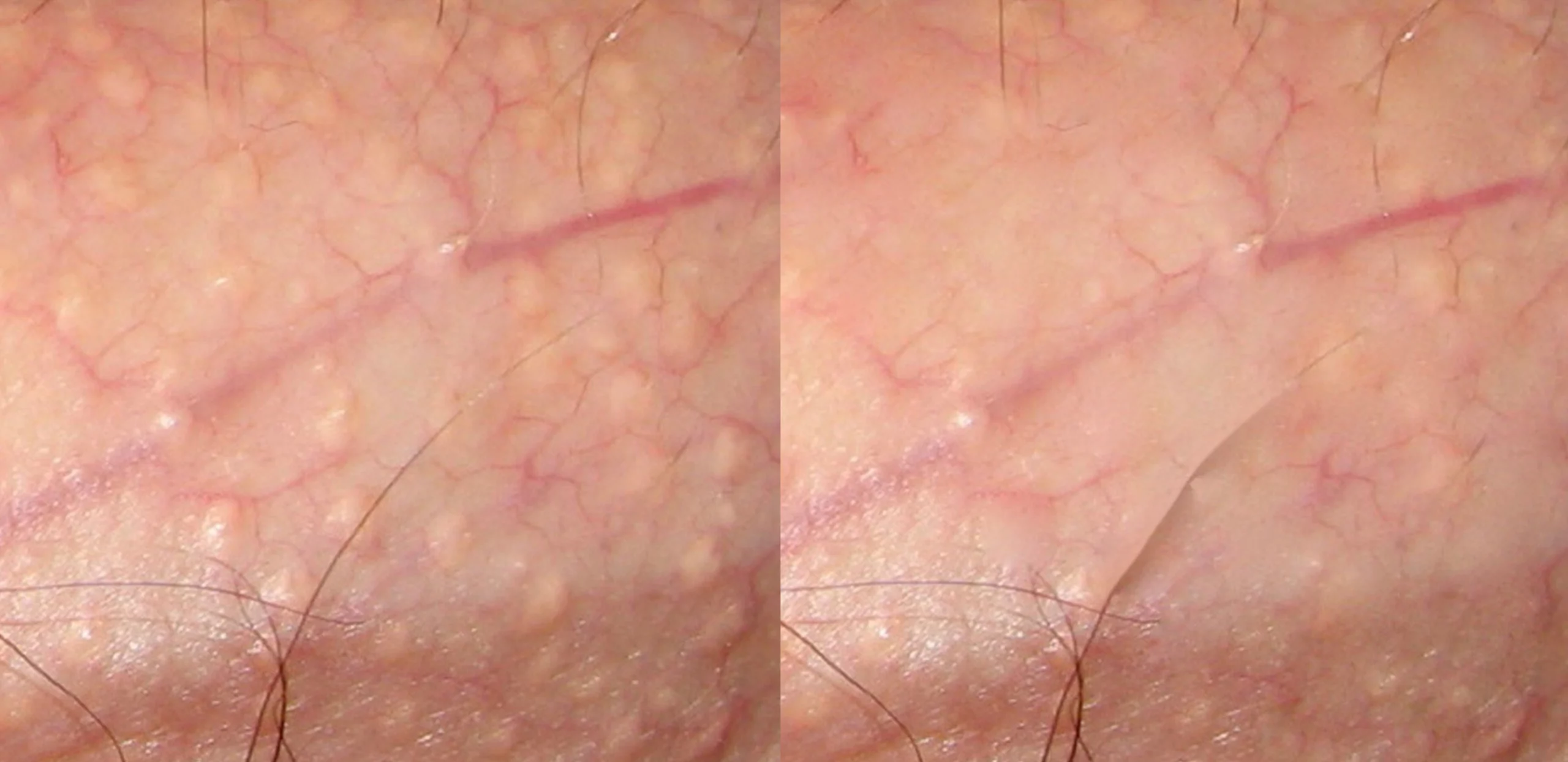 fordyce spots gold coast cutis dermatology brisbane scaled