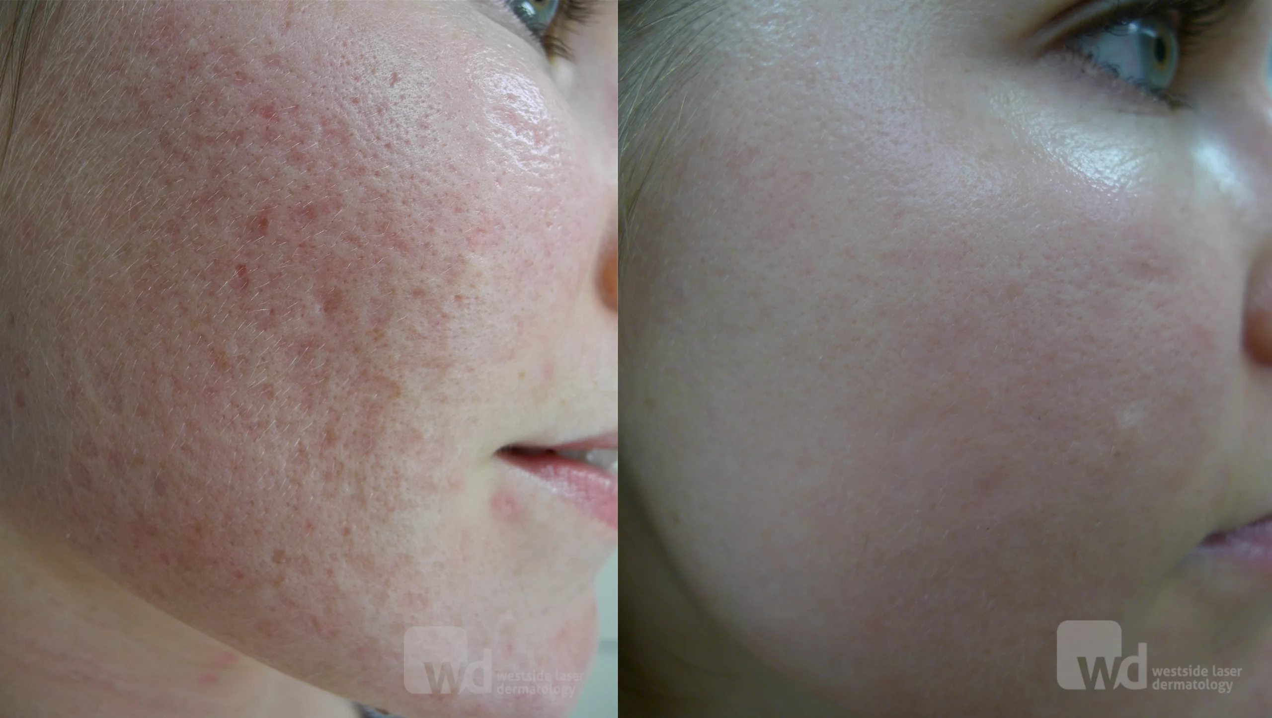 fraxel acne scars treatment cutis dermatology brisbane 1 scaled