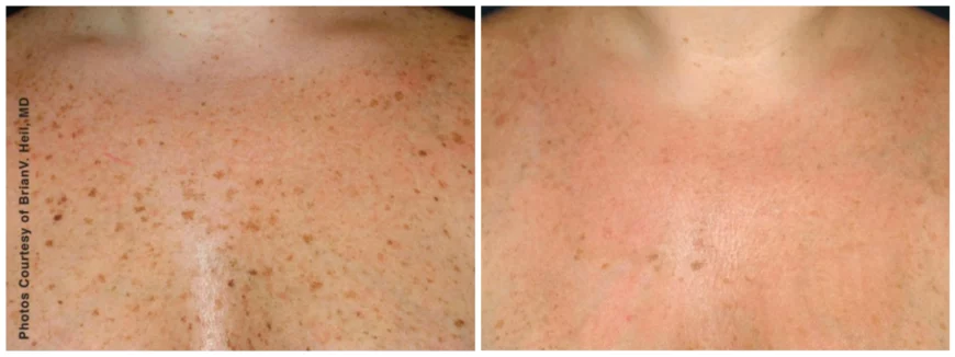 freckles bbl treatment cutis dermatology brisbane