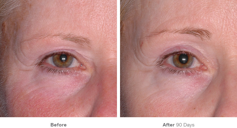 img template beforeafter brow14