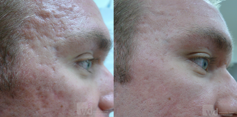 laser treatments acne scar treatment cutis dermatology brisbane