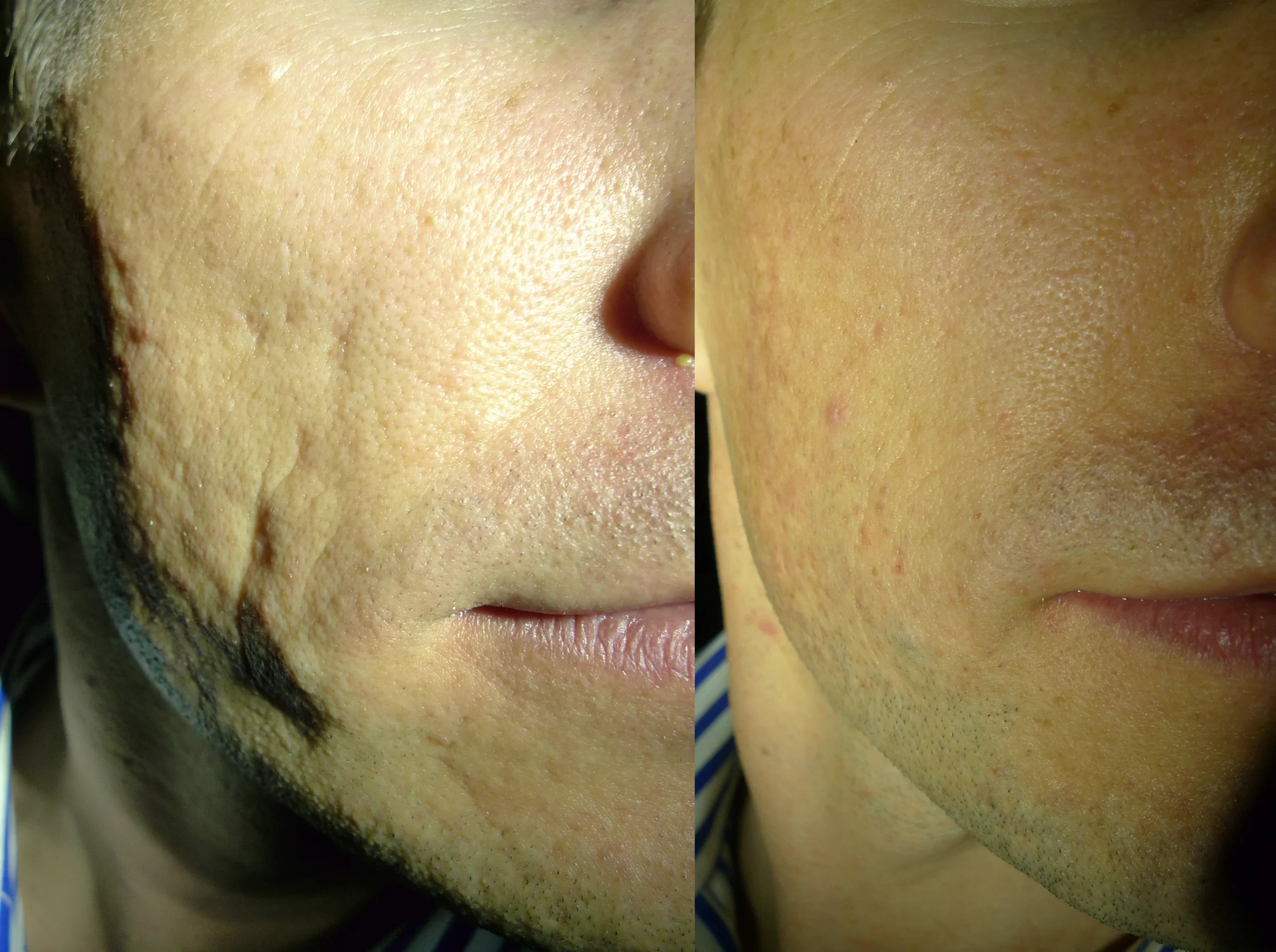 lim acne scar treatment cutis dermatology brisbane scaled