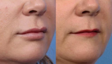 lip filler toowoomba treatment cutis dermatology brisbane