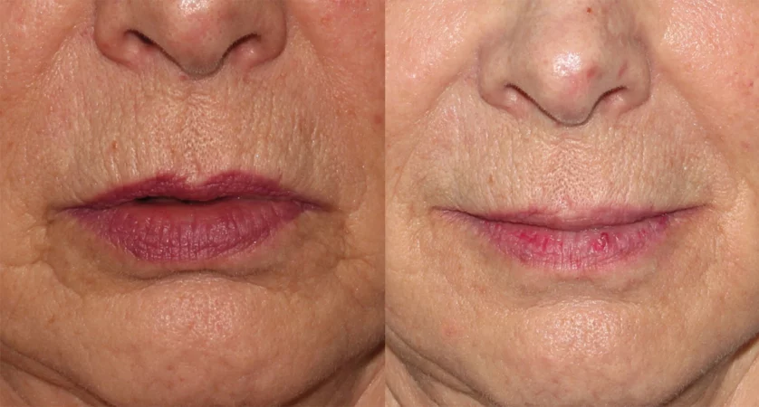 lip lines filler lip rejuvenation treatment cutis dermatology brisbane