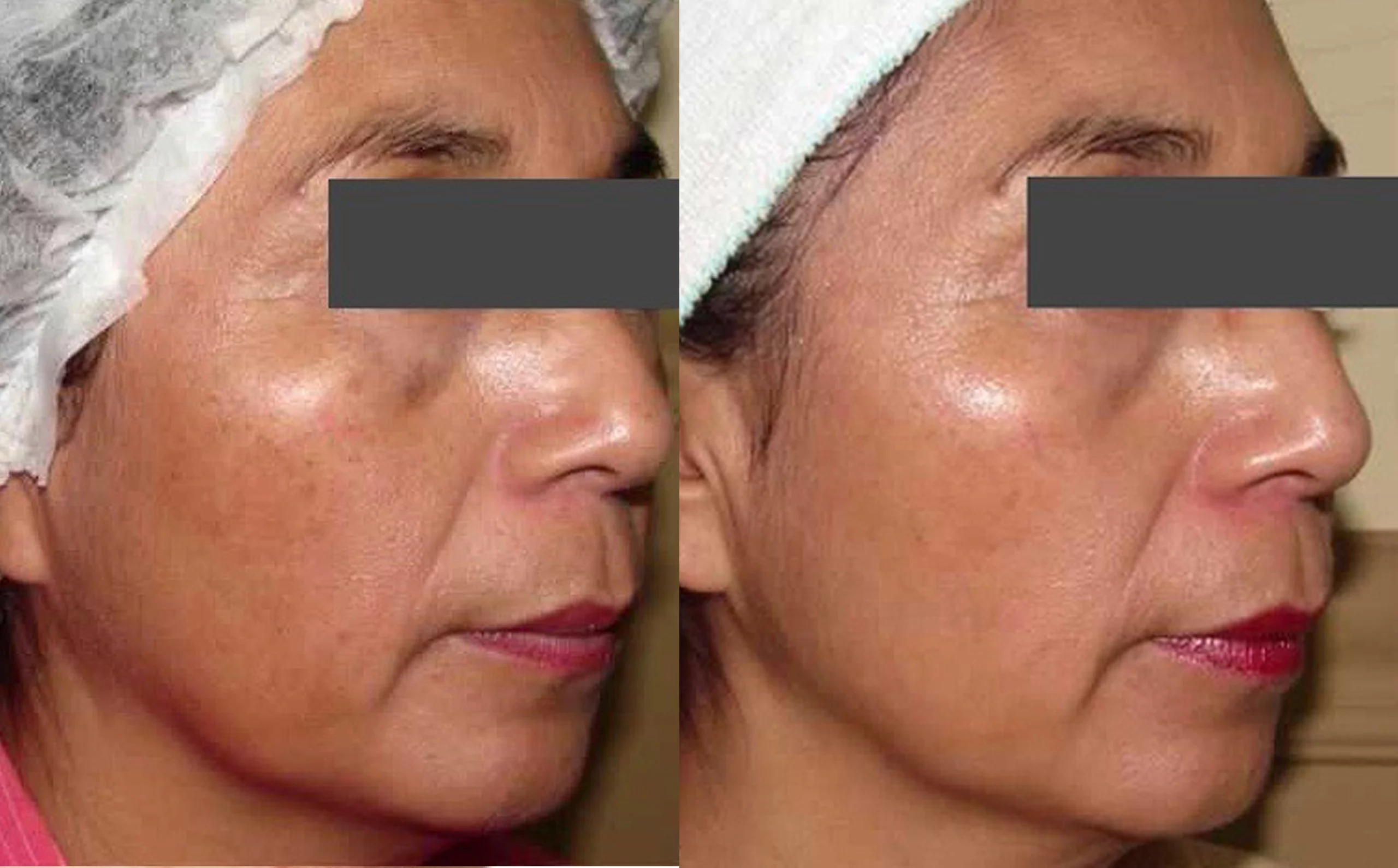 pigmentation treatment cutis dermatology brisbane scaled
