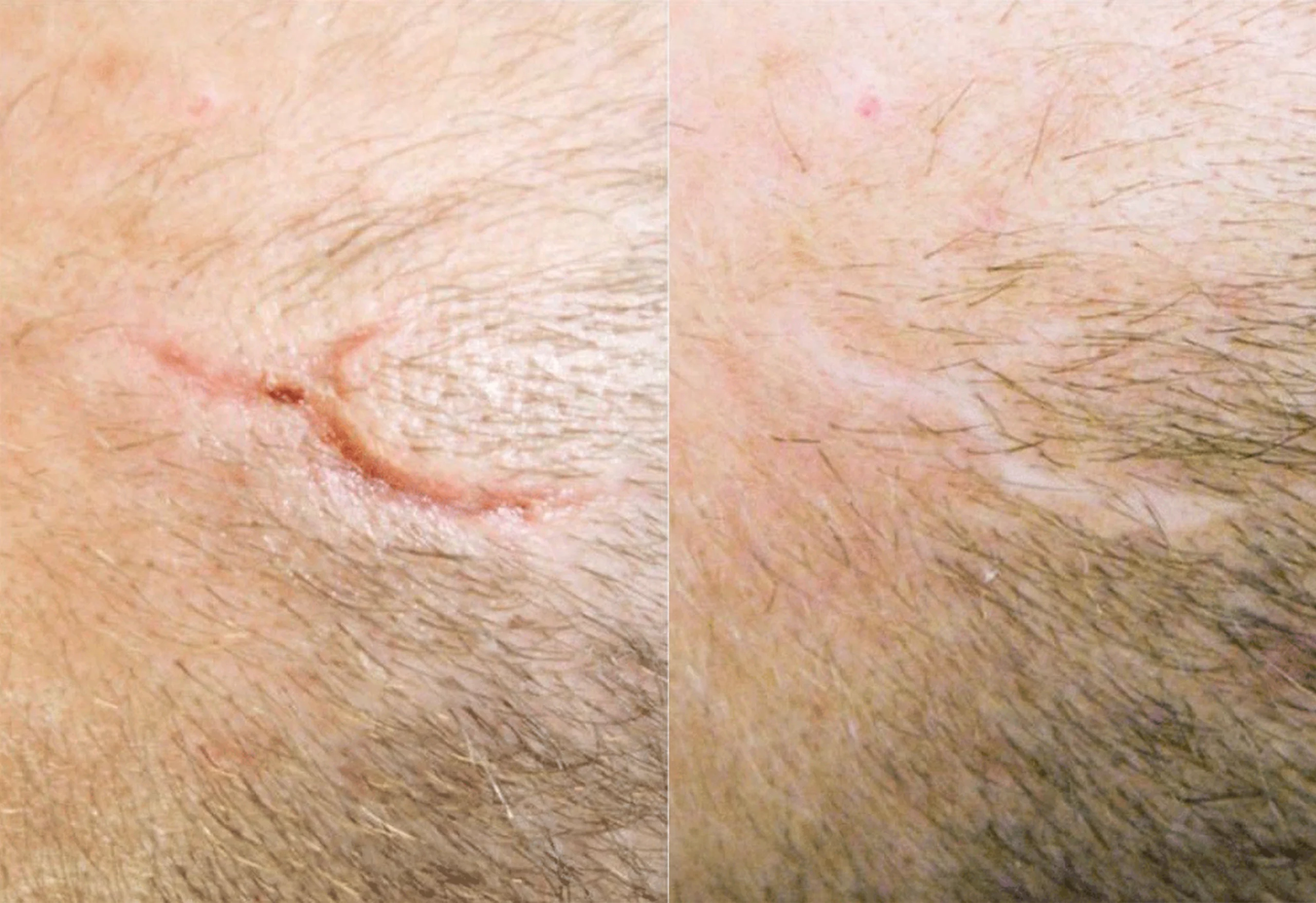 scar gel treatment cutis dermatology brisbane scaled