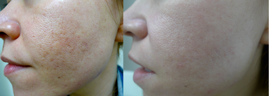 skin needling treatment cutis dermatology brisbane 1