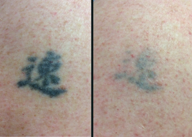 small tattoo removal stage 1