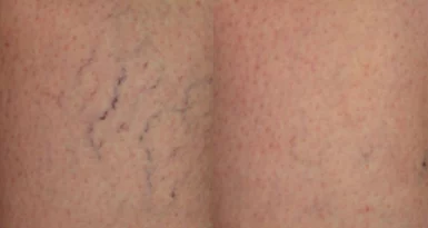 spider veins cutis dermatology brisbane scaled