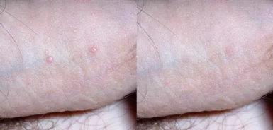 std treatment cutis dermatology brisbane scaled