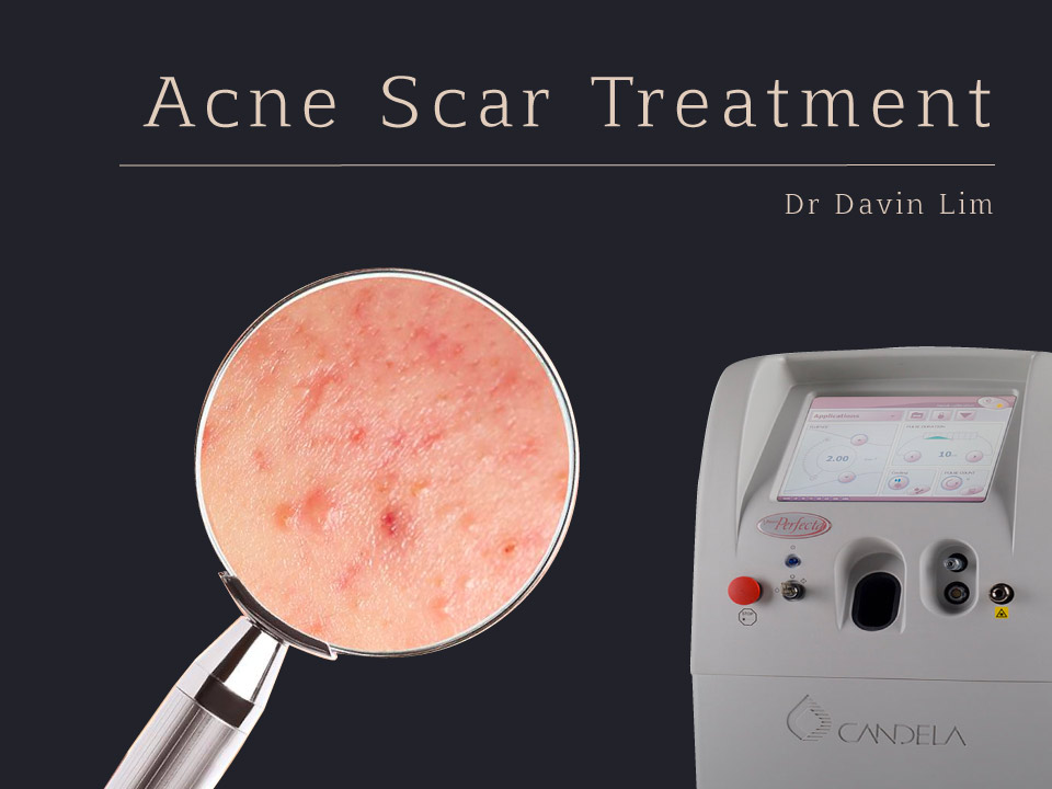 Acne Scar Treatment Dr Davin Lim Brisbane