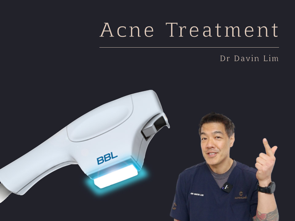 Acne Treatment Broadband Light Dr Davin Lim