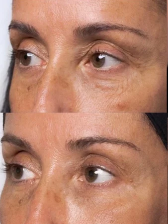 Dermal Fillers Treatment