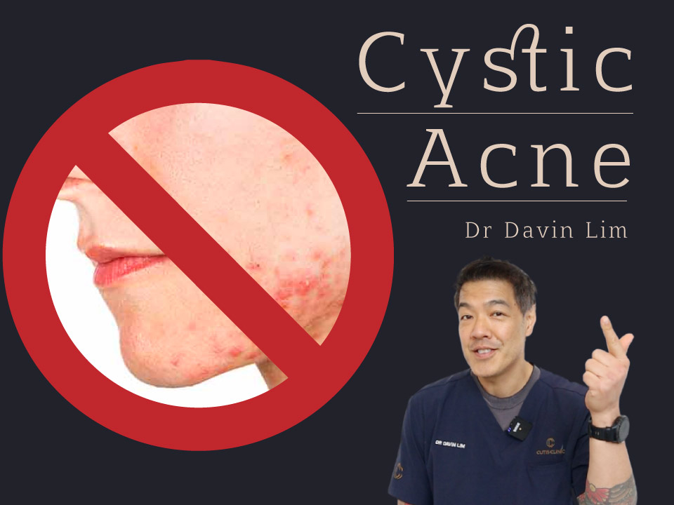 Cystic Acne Treatment Dr Davin Lim Brisbane