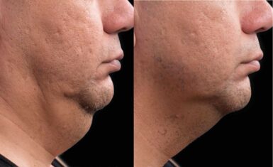 Double chin treatment brisbane 2
