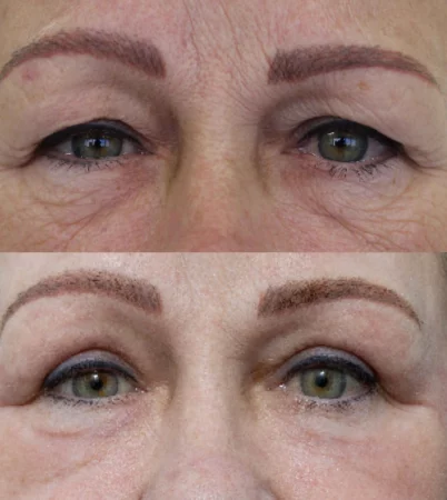Eye Rejuvenation Surgery Treatment