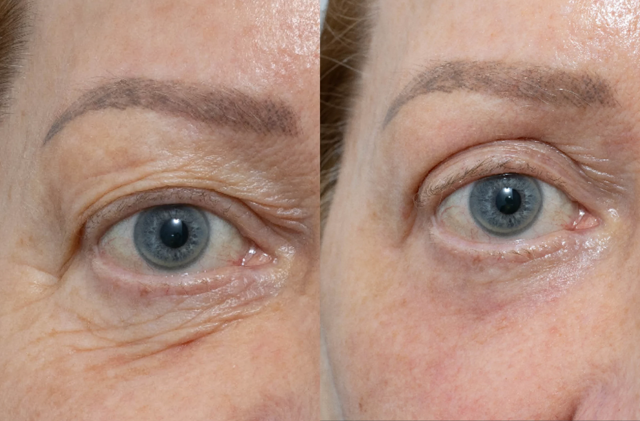 Eye Rejuvenation Surgery Treatment
