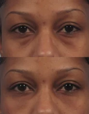 Eye Rejuvenation lasers Treatment
