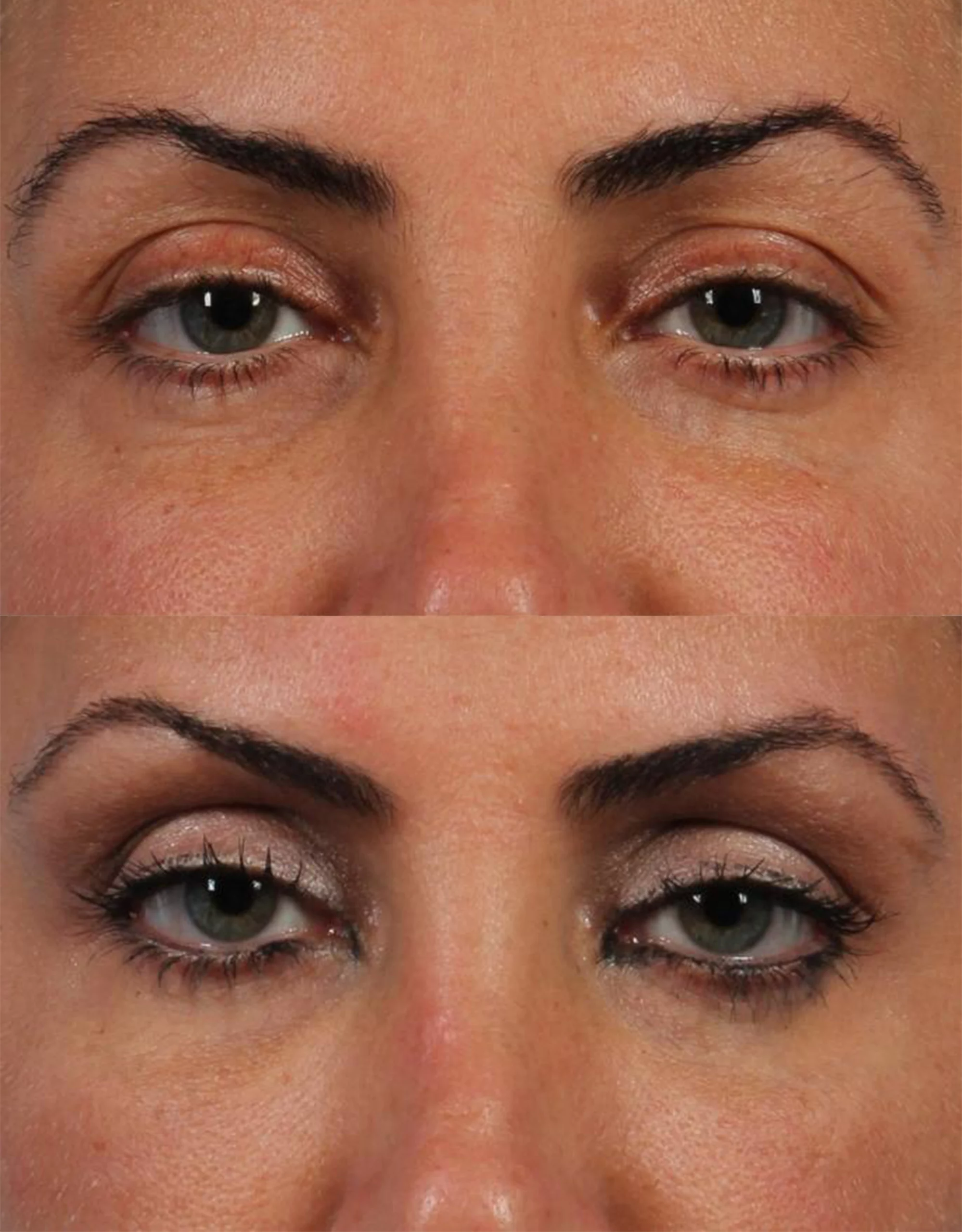 Eye Rejuvenation lasers Treatment