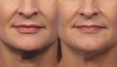 Dermal Fillers Treatment