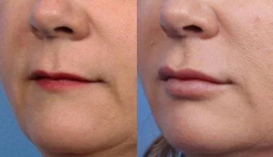 Dermal Fillers Treatment