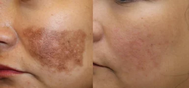 Pigment removal