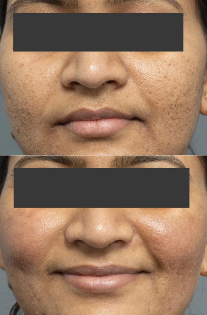 CO2 Laser Resurfacing For Acne Scars - Cutis Dermatology