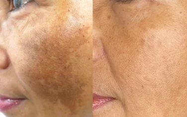 Pigment removal