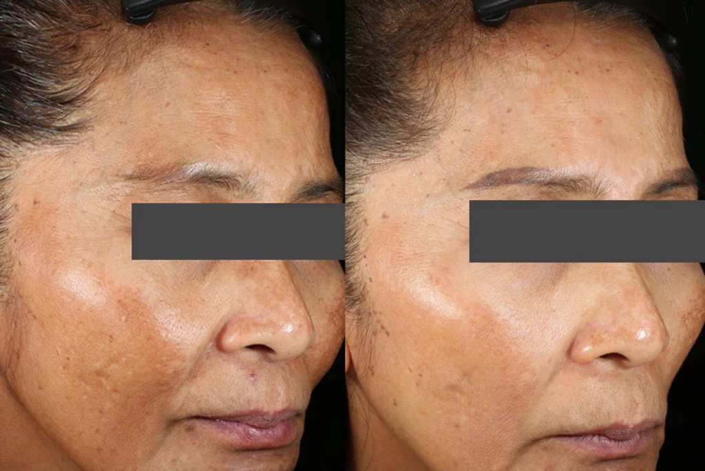 Melasma Pico Cutis Dermatology