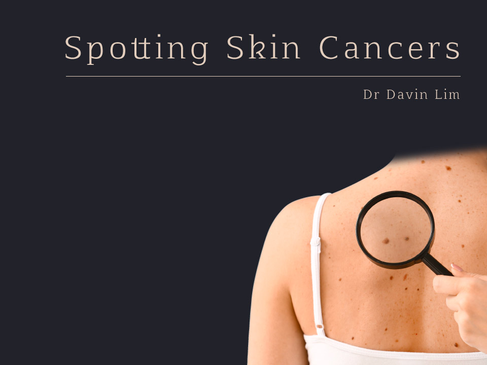Spotting Skin Cancer Dr Davin Lim Brisbane