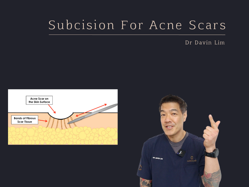 Subcision acne