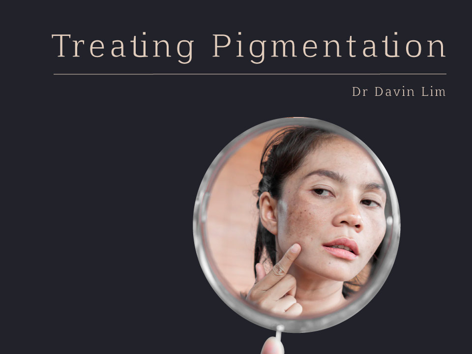 Treating Pigmentation Treatment Dr Davin Lim