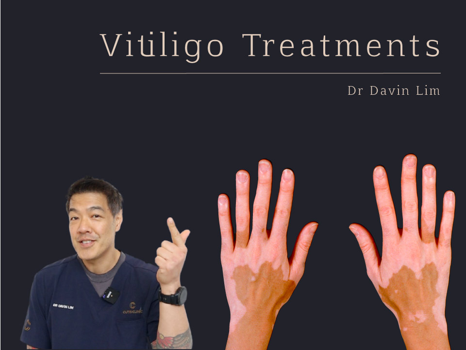 Vitiligo Treatments Dr Davin Lim Brisbane