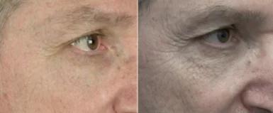 Tixel Eyes Treatment