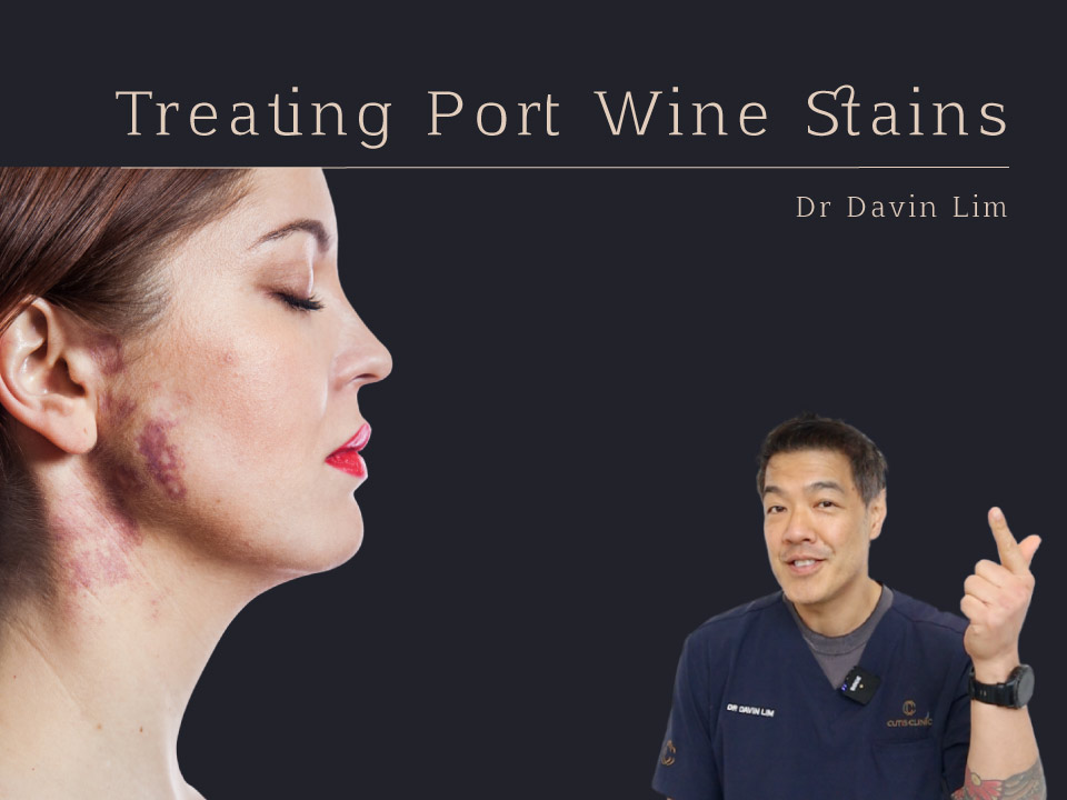 Treating Port Wine Stains Dr Davin Lim
