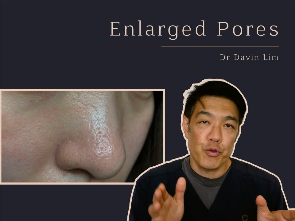 Treating Enlarged pores Dr Davin Lim Brisbane