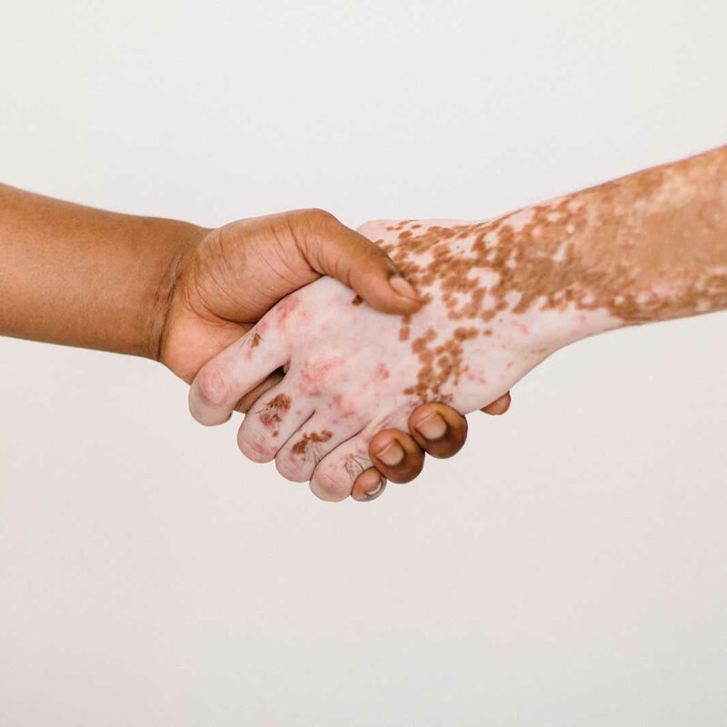 Vitiligo skin care guide