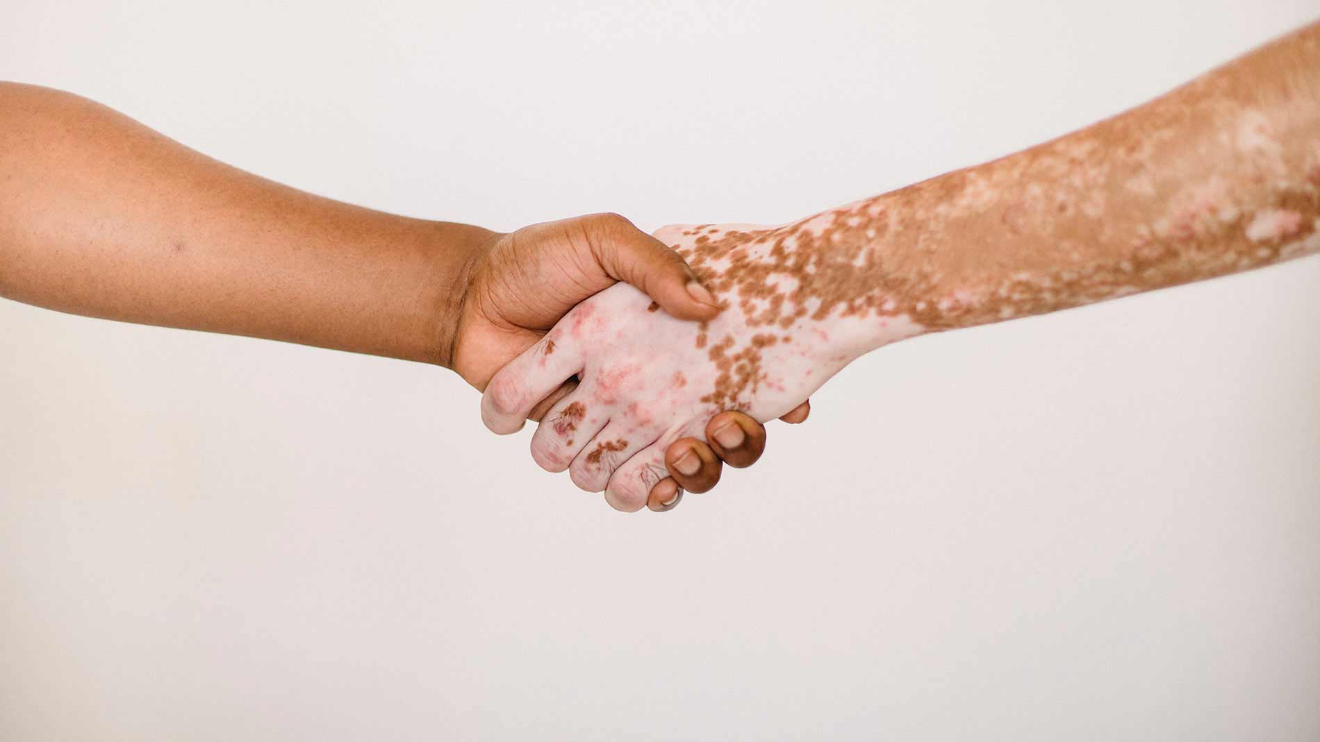Skin Care: Vitiligo